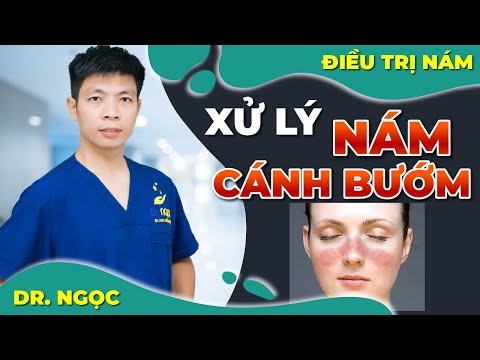 Xử lý NÁM CÁNH BƯỚM như thế nào /DR.NGỌC