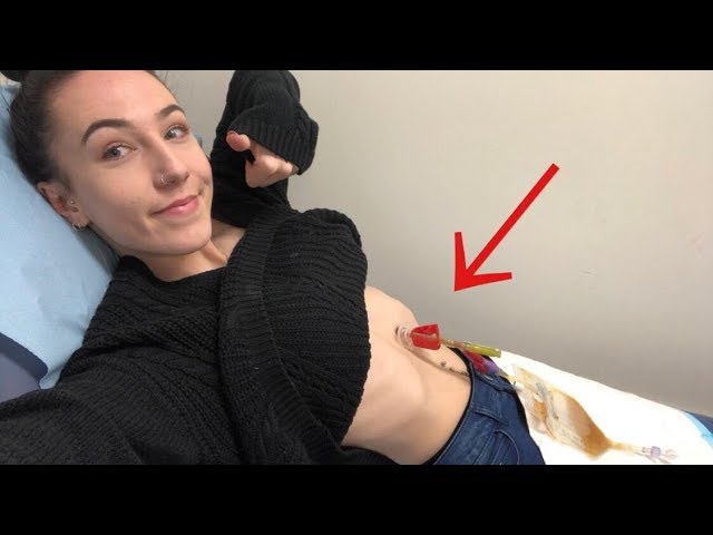 Getting My Granulation Tissue Burned Off 17 09 18 Amy S Life Youtube