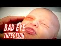 BAD EYE INFECTION (Infant) | Dr. Paul