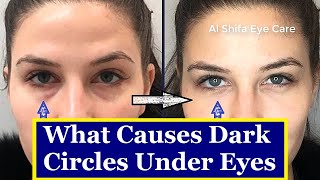 Dark Circles Under Eyes Causes |  Prevention and Treatments in Urdu Hindi