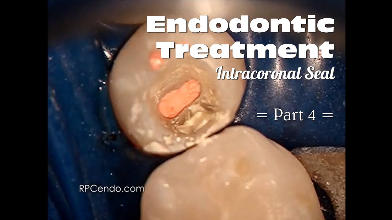 Non Surgical Endodontic Treatment of Tooth 3.5 Part 4 YouTube