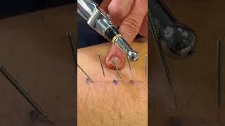 Dry Needling