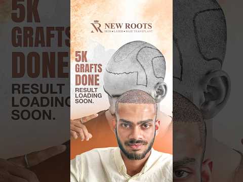 Hair Transplant in Siliguri: Grade 5 Baldness | 5500 Grafts Implanted #hair #viral #shorts