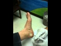 Placing a Cortisone Injection into the Plantar Fascia