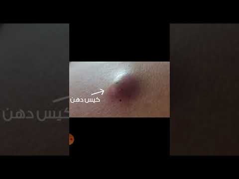 الفرق بين الكيس الدهني والورم   