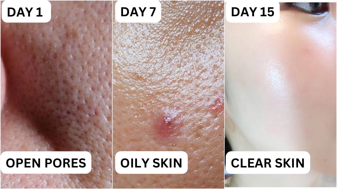 Large Open Pores Oily Skin Open Pores large-open-pores-oily-skin-open-pores