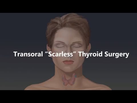 Video: Forårsager thyreoidektomi hypothyroidisme?