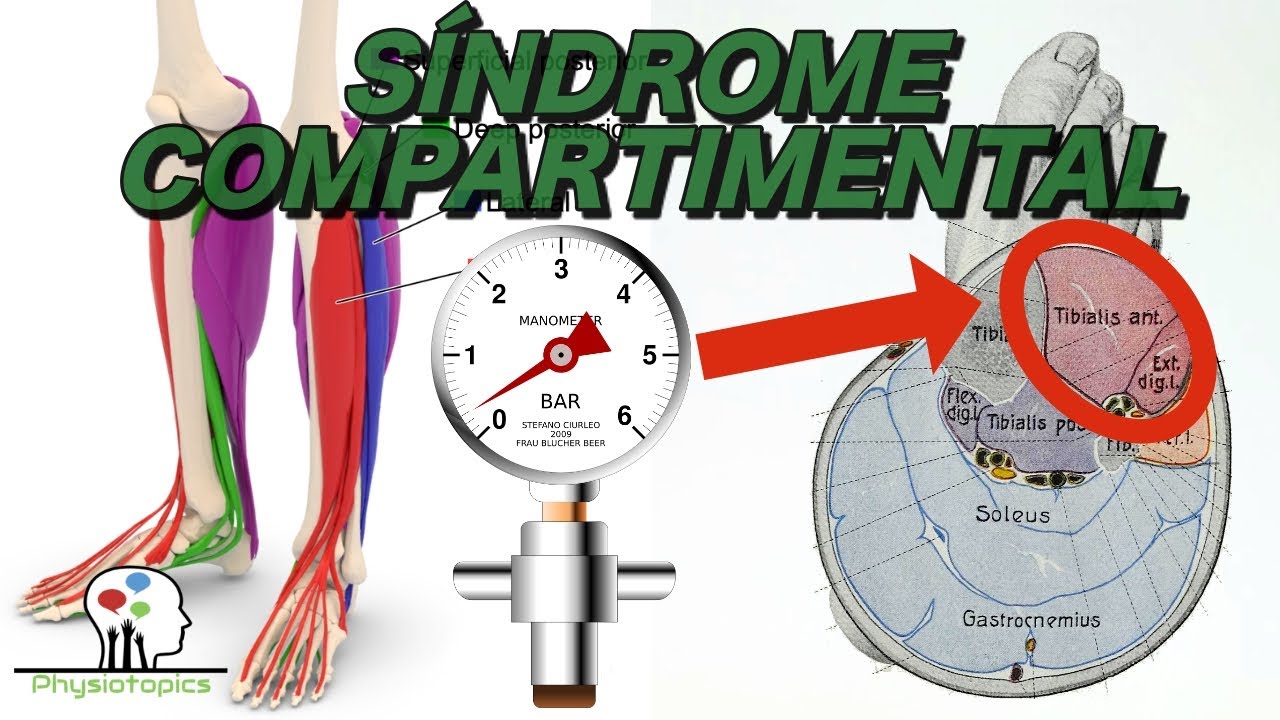 Síndrome Compartimental Agudo