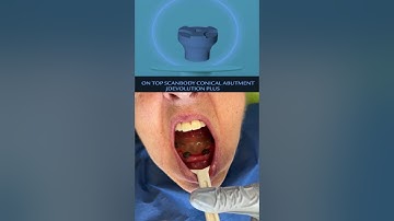 Intraoralscan of mandibular full arch with JD on top scanbody