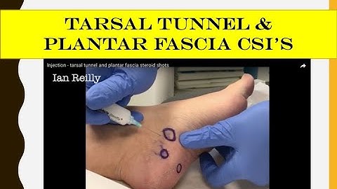 Injection - tarsal tunnel and plantar fascia steroid shots