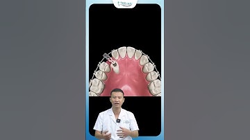 Kéo Răng Mọc Ngầm Niềng Răng | Bác Sĩ Yên
