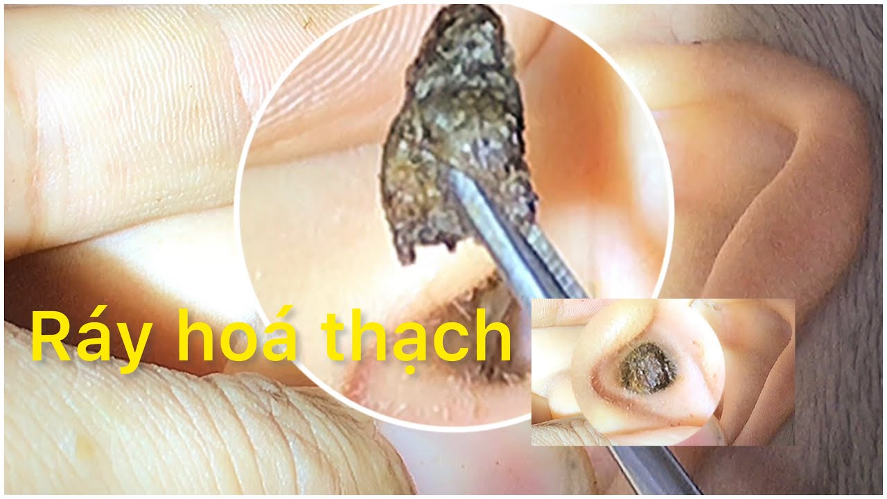 Lấy ráy tai,phần 17 ráy tai hoá thạch trong tai cậu bé- earwax- Y MEN ...