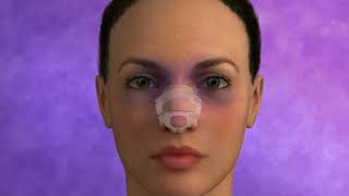 Rhinoplasty Animation