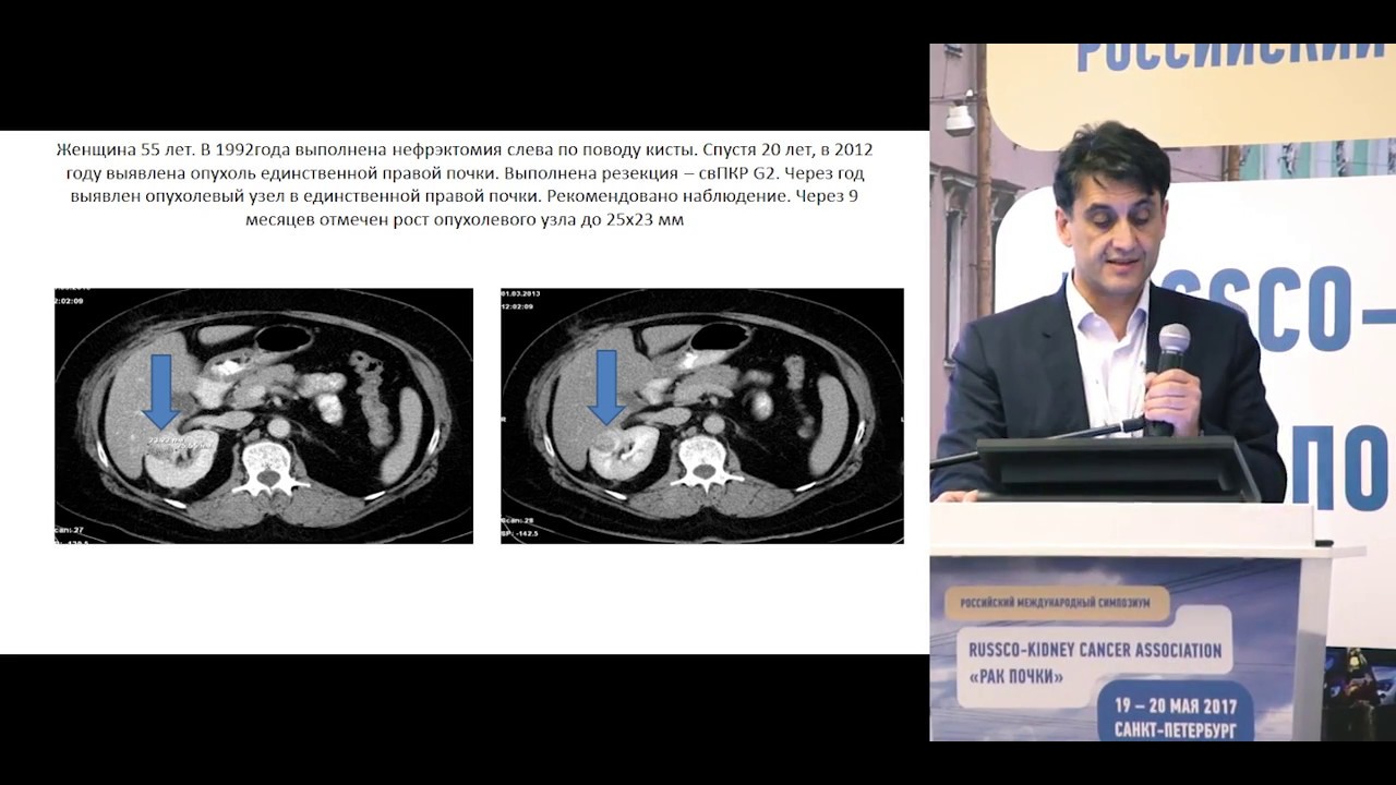 Повторная ипсилатеральная резекция почки в случае рецидива является необоснованной