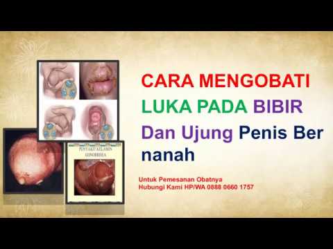Cara Mengobati Luka Pada Bibir Dan Ujung Penis Bernanah 