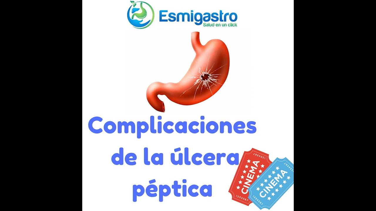 Complicaciones de la Úlcera Péptica saludos amigos dvd