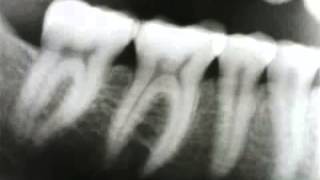 Zubní X-ray