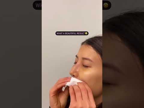 Video thumbnail: Rhinoplasty | Plastic Surgery Cast Removal | Nose Augmentation Before & After #plasticsurgery — Edward S. Kwak MD - ESKMD Facial Plastic Surgery