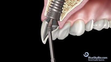Custom Abutment from a Preformed Blank with Screw retained crown