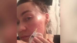 Мезотерапия в домашних условиях( уколы красоты, мезотерапия) Dermaheal SHR. 1 часть