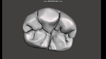 MeshMixer: digital Carving of posterior tooth