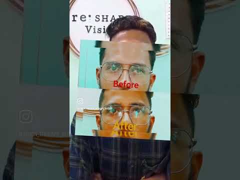 Squint treatment with