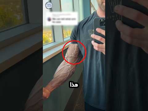 هذا الشاب أثار الجدل بسبب وريد واحد في جسده