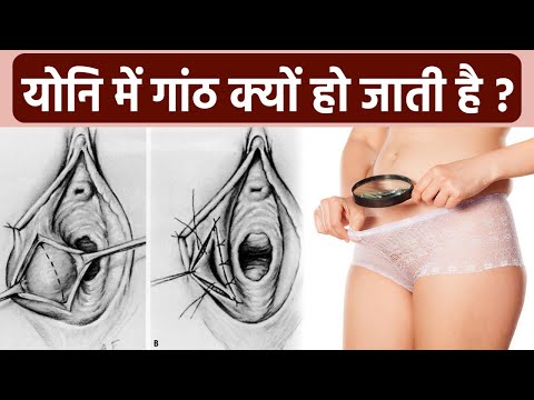 योनि में गांठ Bartholin Cyst का Symptoms, कारण जानना जरूरी Doctors Advice | Boldsky