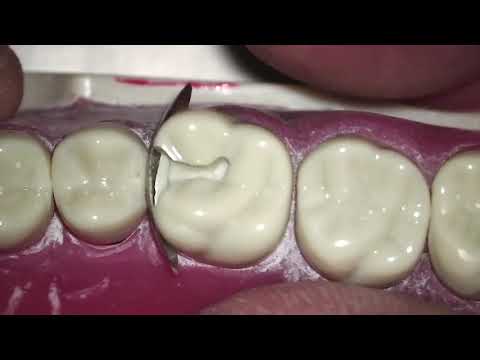 Class II Butter-Spreader Technique by Dr. Reuben Kim