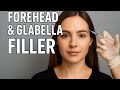 Forehead &amp; Glabella Filler Injection | تزریق فیلر پیشانی و خط اخم