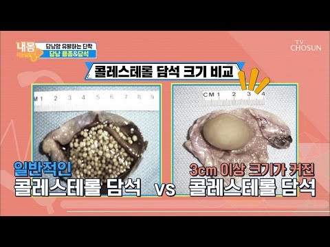 담낭 건강 의심되는 이상신호는 내 몸 사용설명서 277회 20191122 