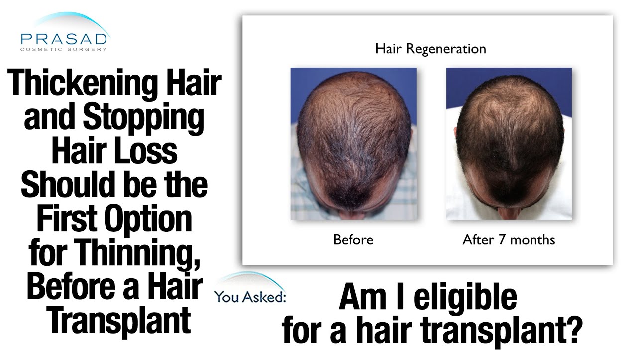 Hair Transplant Limitations  NY Hair Loss