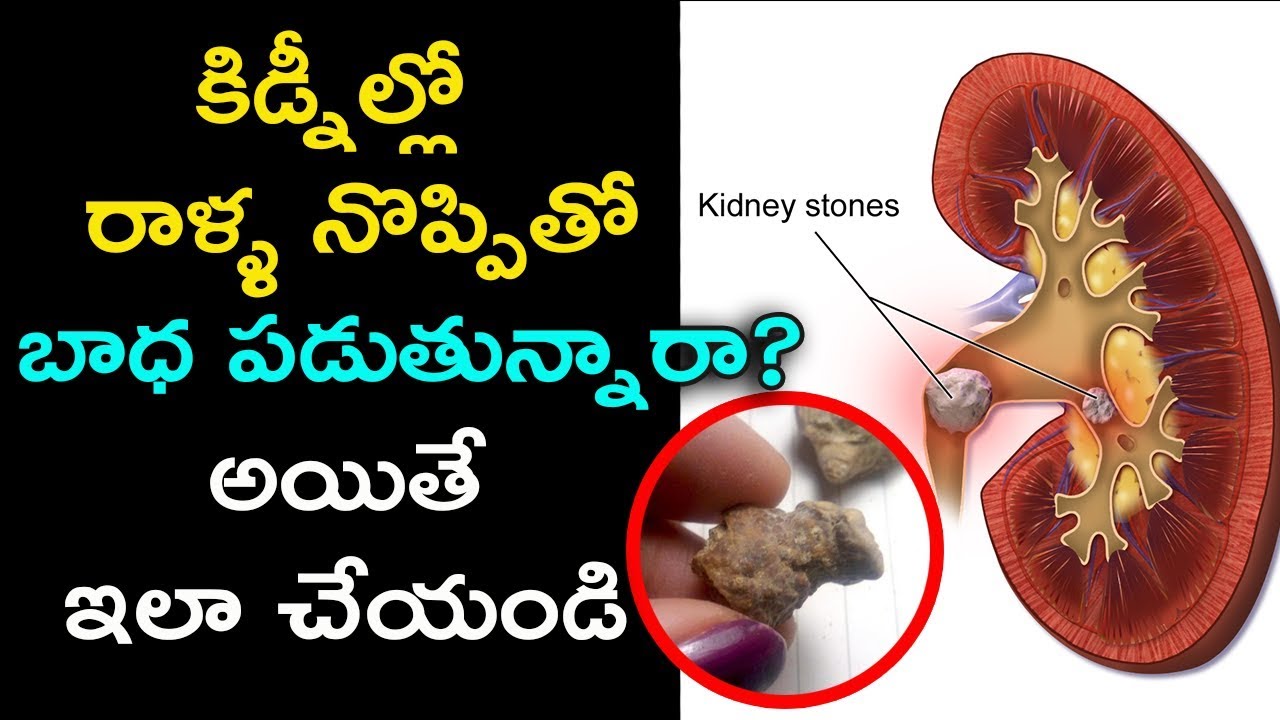 Kidney Stone Pain Relief at Home in Telugu కిడ్నీ రాళ్ళ నొప్పితో భాధ