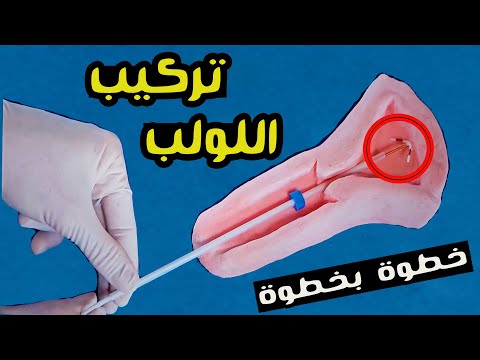 شاهد كيف يمكن تركيب اللولب خطوة بخطوة