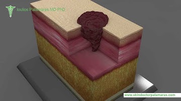 Mohs Micrographic Surgery by Dr Palamaras