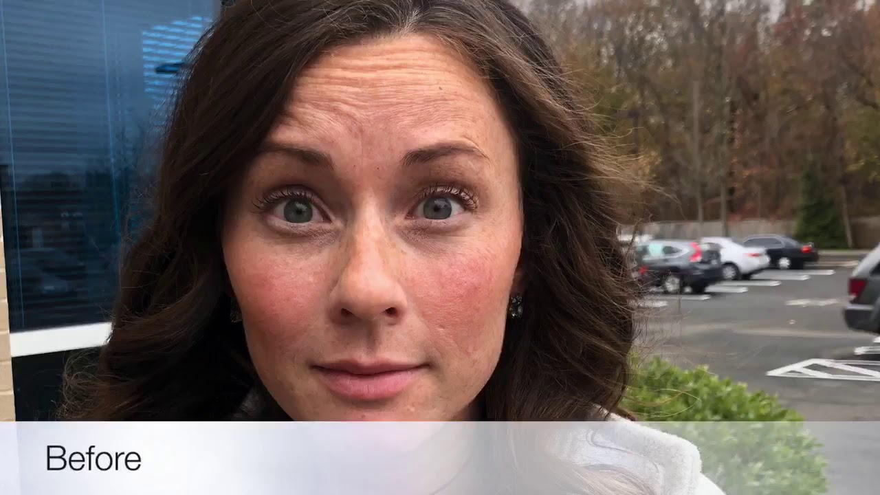 Before and After Botox Results at Dr. Paul Fischer in Milford, CT by Caitlin Houston