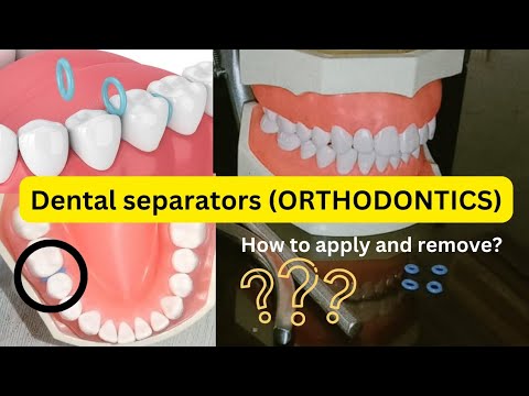 Orthodontic spacers or separator- placement and removal