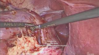 Laparoscopic upper moeity nephrectomy in an infant with Right Duplex system with ectopic ureter