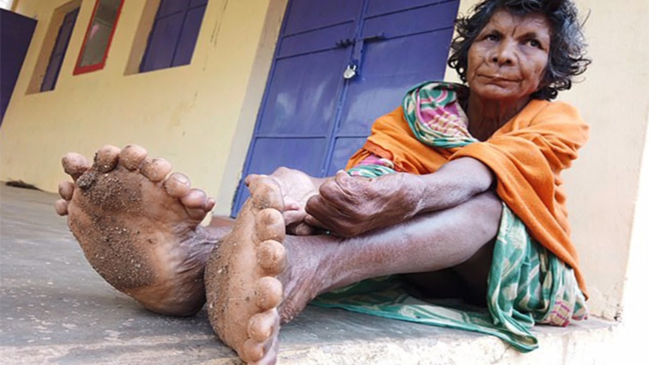 Женщина с 31 пальцем - Невероятные факты ( Полидактилия)