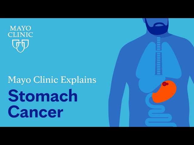 Mayo Clinic explains stomach cancer class=