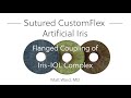 Sutured CustomFlex Artificial Iris - Flanged Coupling of Iris-IOL Complex