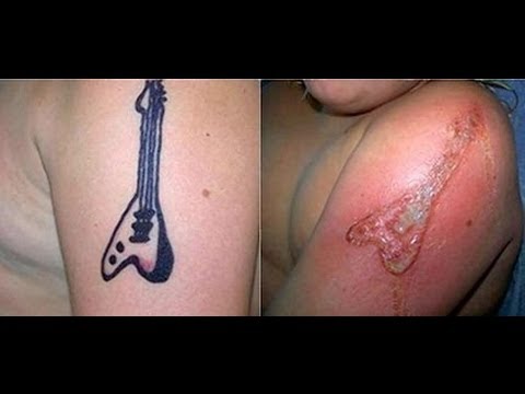 Caution Black Henna Temporary Tattoos Could Leave Permanent Scars