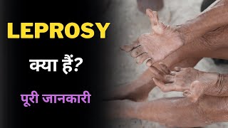 What is Leprosy with Full Information? – [Hindi] – Quick Support