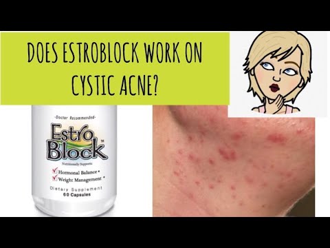 MUST WATCH - Estroblock Review - Does It Work to Cure Cystic Acne?