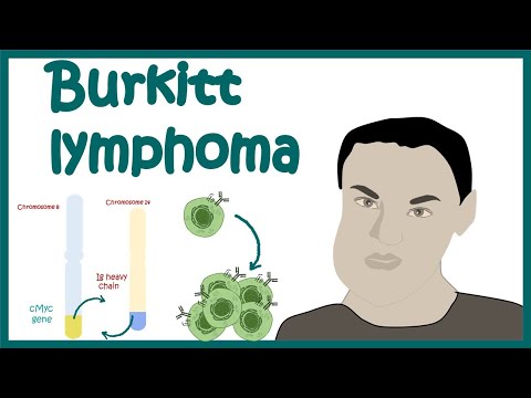 Burkitt’s Lymphoma | Aggressive B-Cell Non-Hodgkin’s Lymphoma | Cellular basis of Burkitt’s Lymphoma