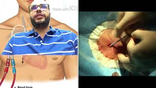 القسطرة الوريدية المركزية للتمريض الجزء الأول centeral venous line , cvp part I