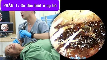 PHẦN 1: Ca đặc biệt ở cụ bà 耳かき - ASMR耳掃除 | Bác sĩ Hiệu Long Biên