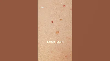 أسباب النقاط الحمراء على الجلد 
