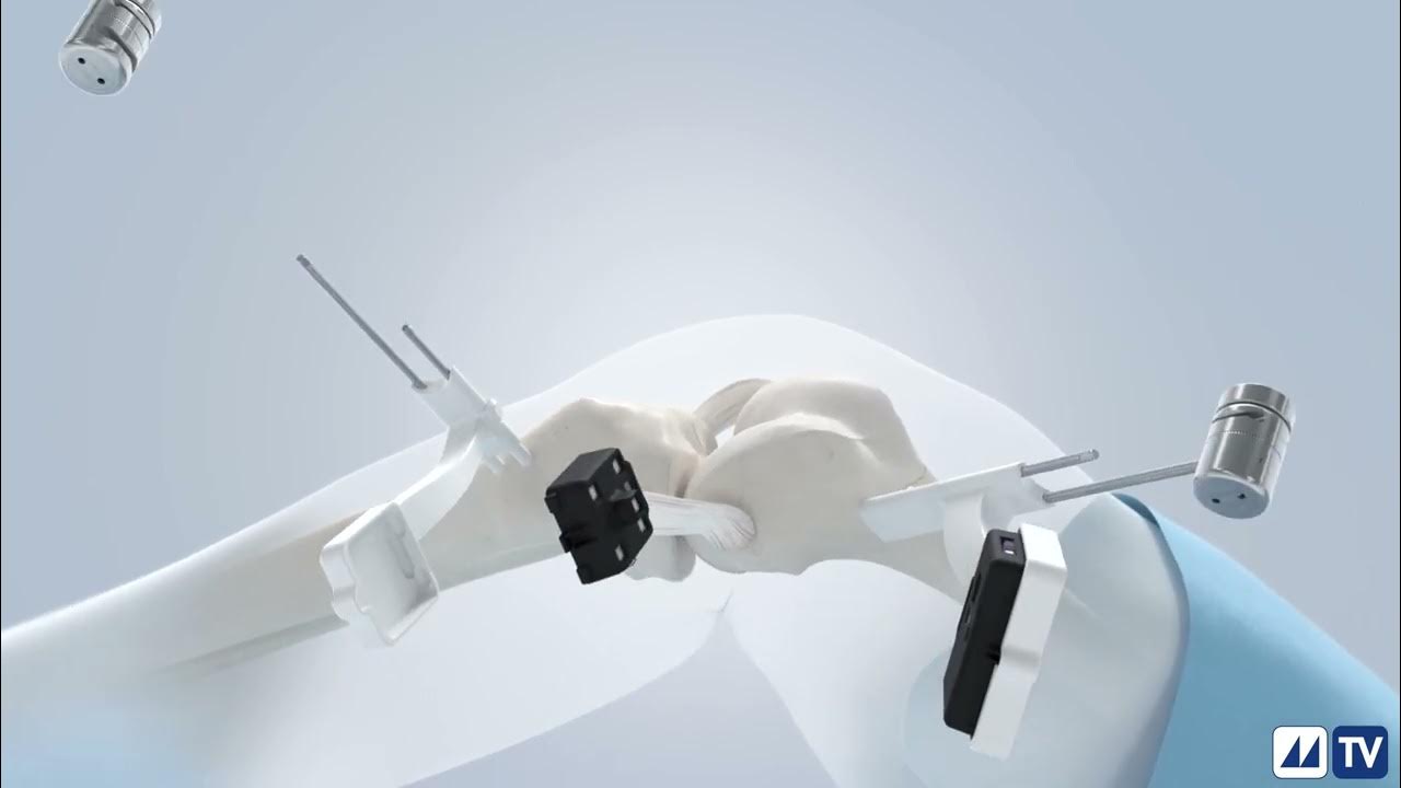 Augmented Reality application for Knee replacement YouTube