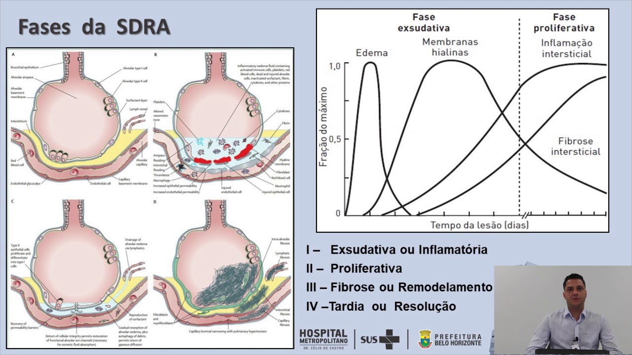 Síndrome respiratória aguda grave por COVID19 YouTube Síndrome respiratória aguda grave por COVID19 YouTube